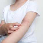 中大口服微囊鎖活菌微生態配方SIM03 有效紓緩兒童濕疹